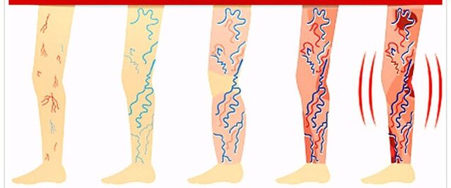 wat je niet moet doen bij spataderen