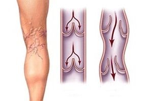 uitstroom van bloed in spataderen in verschillende stadia van de ziekteontwikkeling